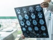 ASTUCE Spain exigeix equitat per als pacients amb oligodendroglioma
